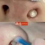 VÍDEO! DENTE NASCE DENTRO DO NARIZ DE CRIANÇA.